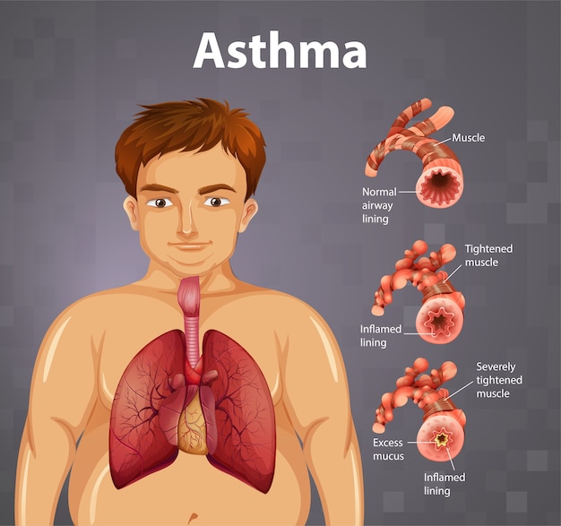 Vector gratuito comparación de pulmón sano y pulmón asmático