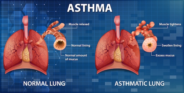 Comparación de pulmón sano y pulmón asmático