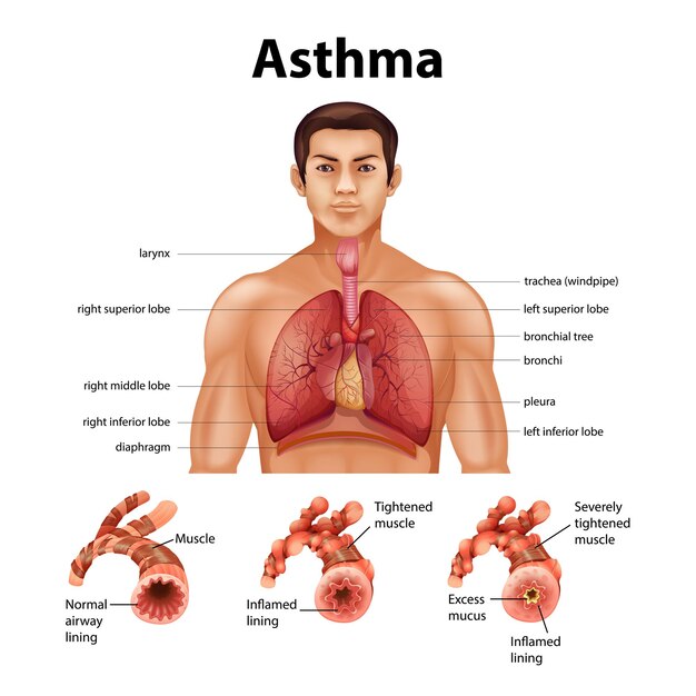 Comparación de pulmón sano y pulmón asmático