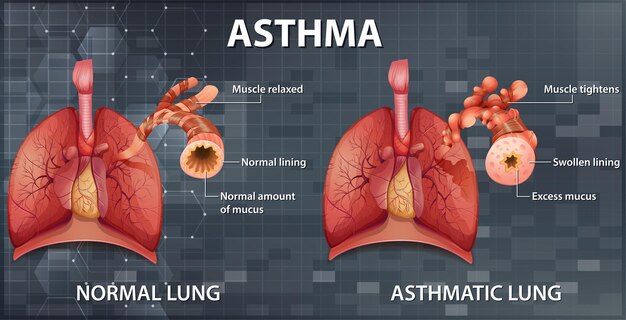 Comparación de pulmón sano y pulmón asmático
