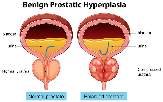 Comparison of Normal and Enlarged Prostate Glands