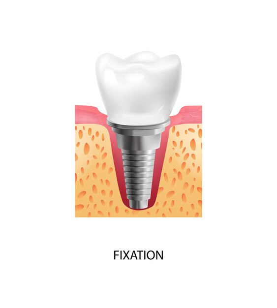 Composición de implantes dentales de etapas dentales realistas con texto y vista de la etapa de fijación de la ilustración vectorial de implantación dental