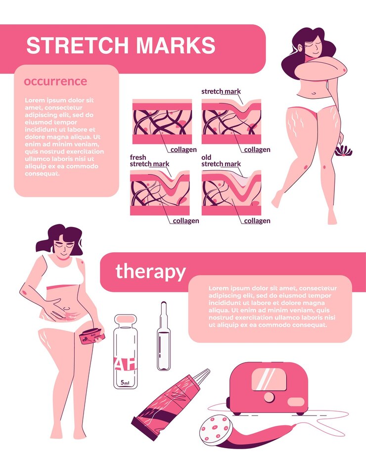 Vector gratuito composición infográfica plana de estrías con texto editable y personajes femeninos con estructura de piel productos cosméticos ilustración vectorial