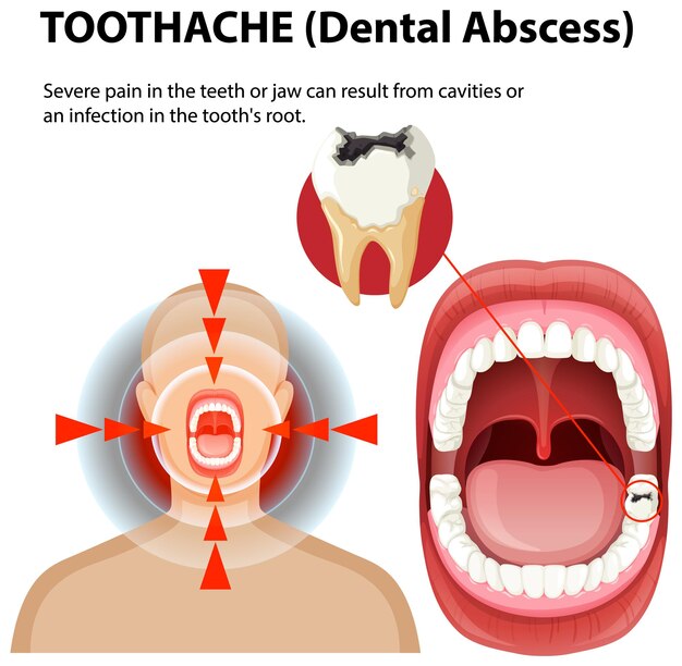 Comprender el absceso dental y el dolor de dientes