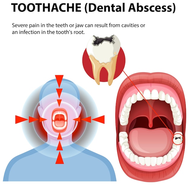 Comprender el absceso dental y el dolor de dientes