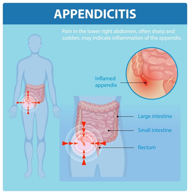 Comprender la apendicitis y sus síntomas