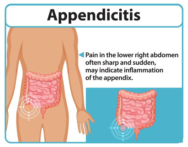 Comprender la apendicitis y sus síntomas