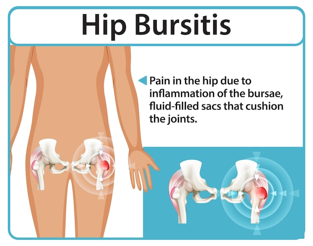 Comprender la bursitis de cadera y sus efectos