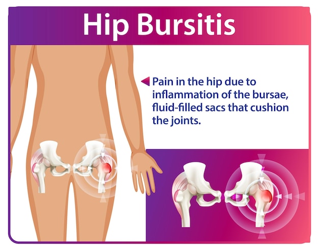 Comprender la bursitis de cadera y sus efectos