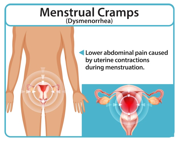 Comprender los calambres menstruales y la dismenorrea