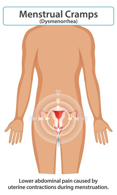 Comprender los calambres menstruales y la dismenorrea