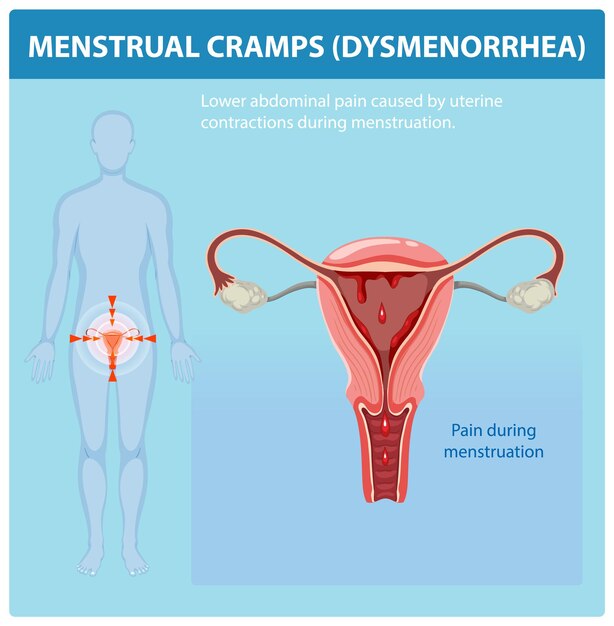 Comprender los calambres menstruales y la dismenorrea