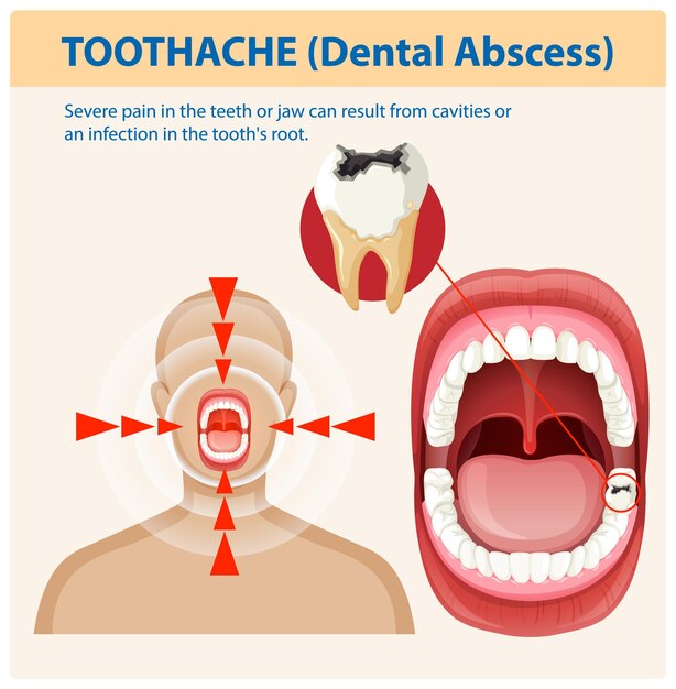 Comprender el dolor de dientes y el absceso dental