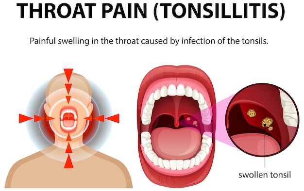 Comprender el dolor de garganta y la amigdalitis