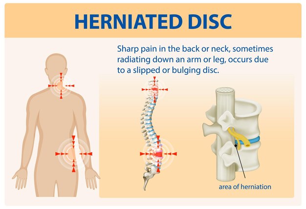 Comprender el dolor de la hernia de disco