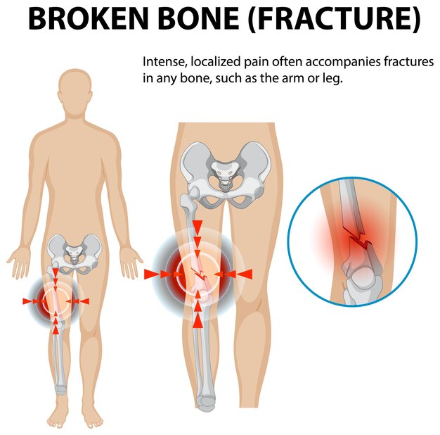 Comprender las fracturas óseas y el dolor
