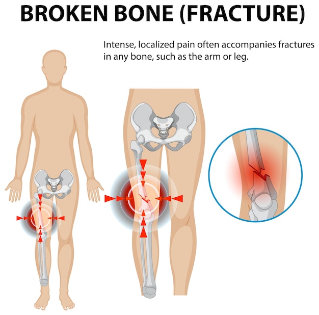 Comprender las fracturas óseas y el dolor
