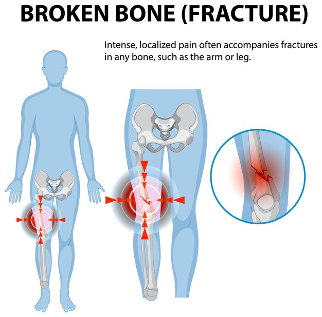 Comprender las fracturas óseas y el dolor