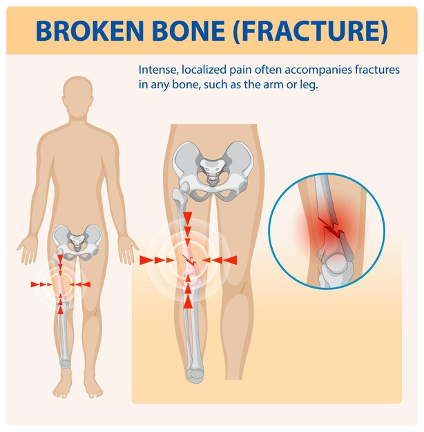 Comprender las fracturas óseas y el dolor