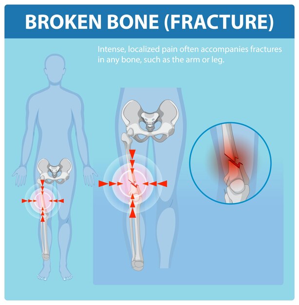 Comprender las fracturas óseas y el dolor