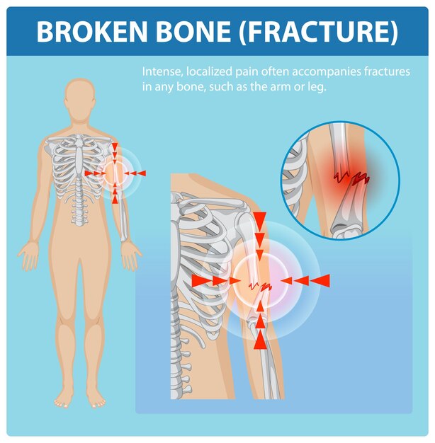 Comprender las fracturas óseas y el dolor