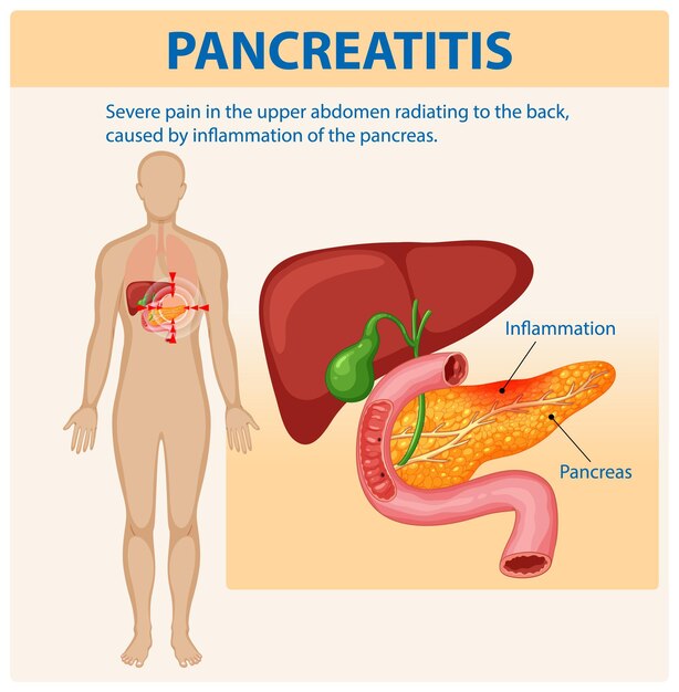 Comprender la pancreatitis y sus síntomas