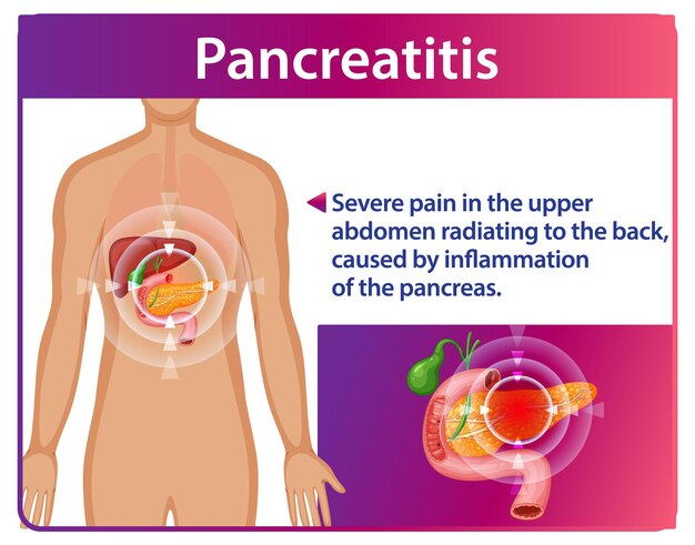 Comprender la pancreatitis y sus síntomas