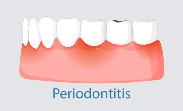 Comprender la periodontitis y la salud bucal