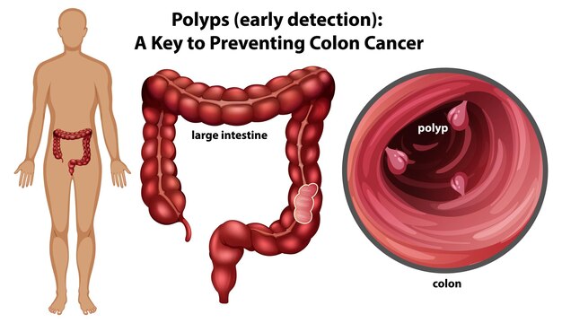 Comprender los pólipos del colon y su prevención