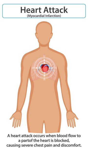 Comprender los síntomas de un ataque al corazón