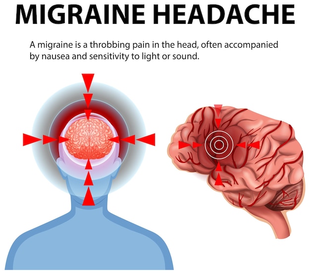Comprender los síntomas de la migraña