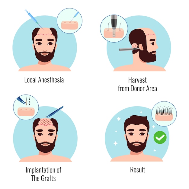 Concepto de diseño con hombre barbudo en las etapas del procedimiento de trasplante de cabello aislado