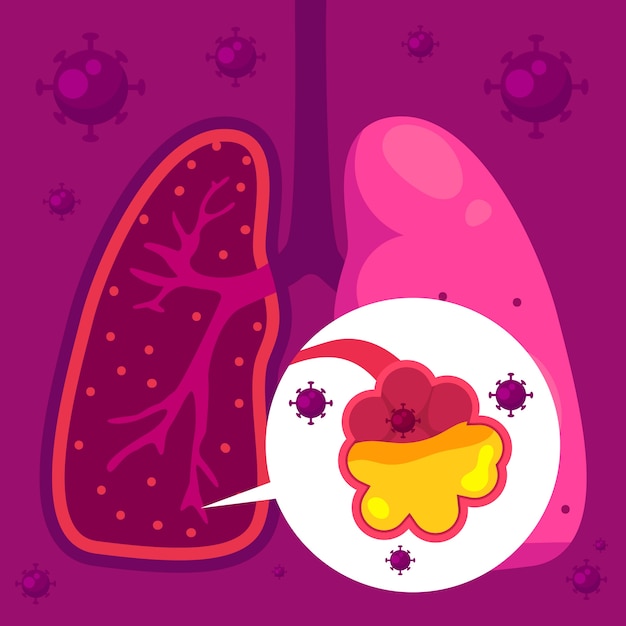 Vector gratuito concepto de neumonía por coronavirus