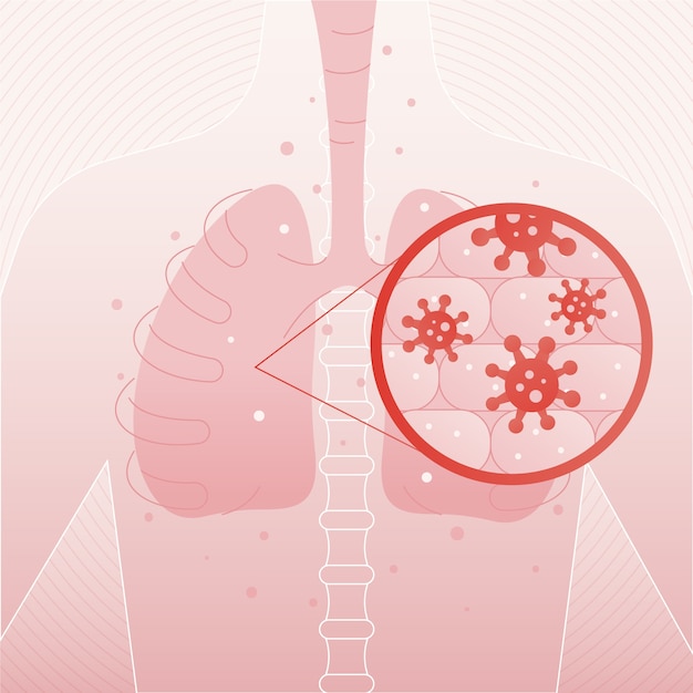 Vector gratuito concepto de neumonía por coronavirus