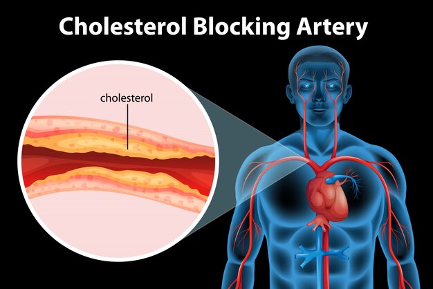 Condición médica de la ateriosclerosis