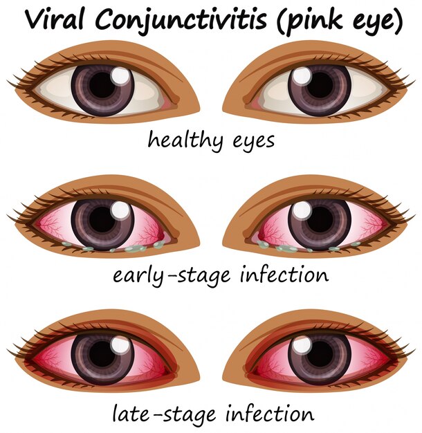 Conjuntivitis viral en ojos humanos