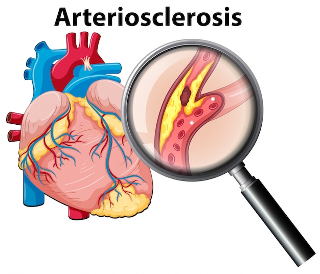 Vector gratuito corazón humano y arteriosclerosis