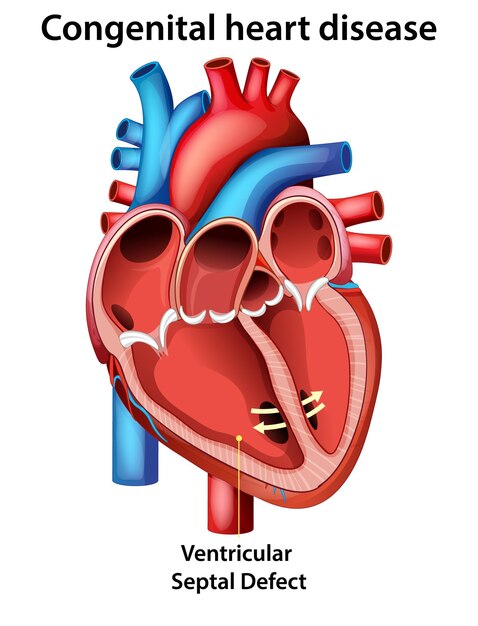 Defecto septal ventricular en enfermedad cardíaca congénita