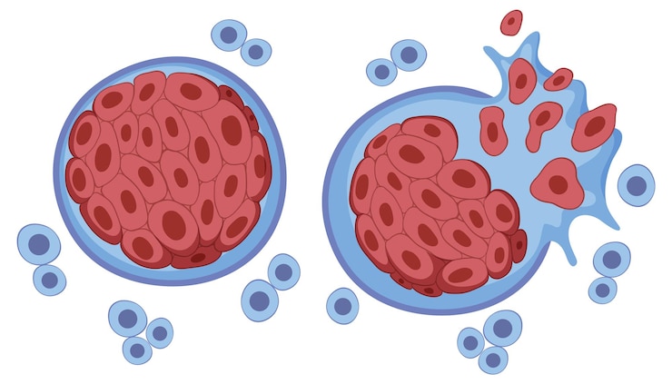 Vector gratuito desarrollo de células tumorales y cáncer