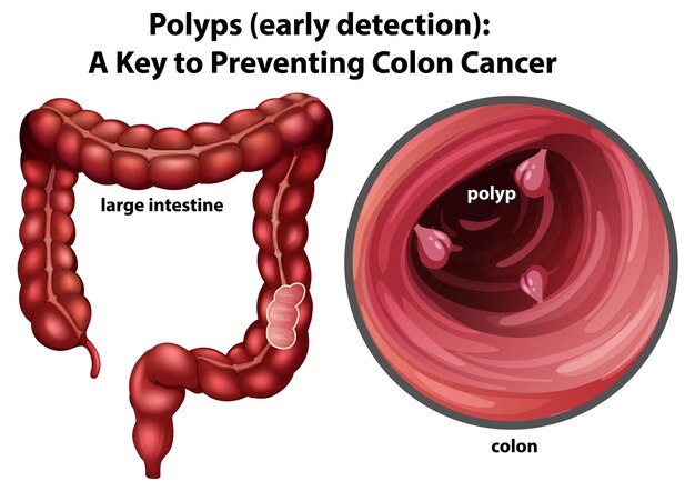 Detección temprana de pólipos en el colon