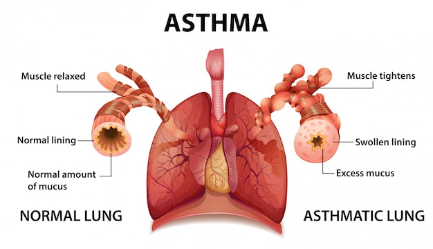 Diagrama de asma de anatomía humana