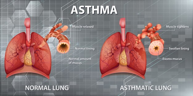 Diagrama de asma de anatomía humana