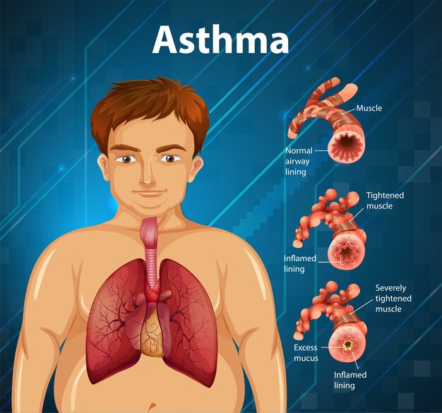 Diagrama de asma de anatomía humana