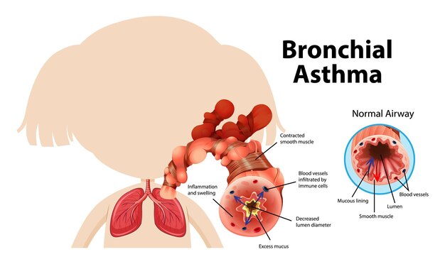 Diagrama de asma bronquial con vía aérea normal y vía aérea asmática