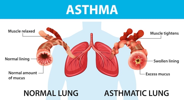 Vector gratuito diagrama de asma con pulmón normal y pulmón asmático