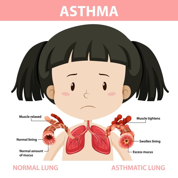 Diagrama de asma con pulmón normal y pulmón asmático