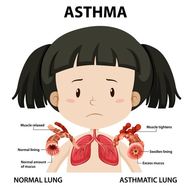 Diagrama de asma con pulmón normal y pulmón asmático