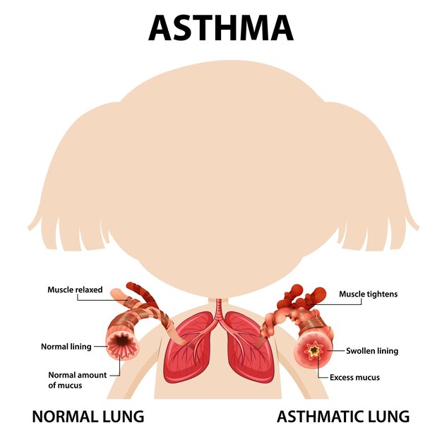 Diagrama de asma con pulmón normal y pulmón asmático
