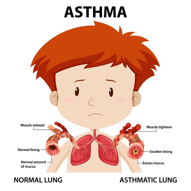 Diagrama de asma con pulmón normal y pulmón asmático