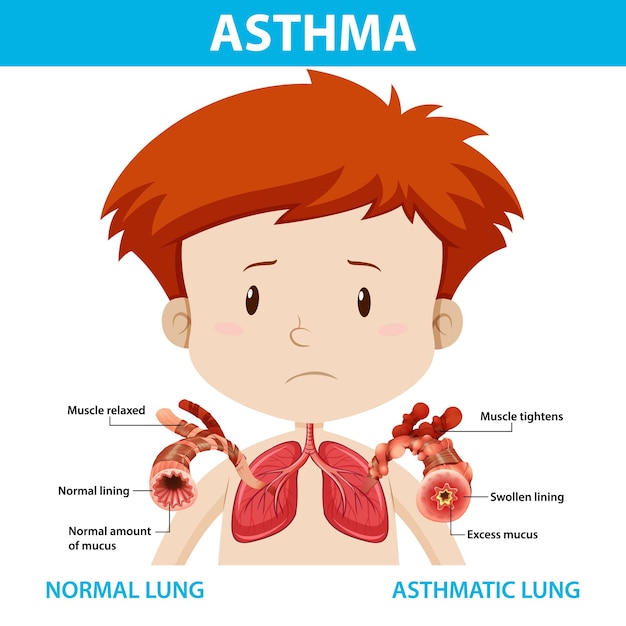 Vector gratuito diagrama de asma con pulmón normal y pulmón asmático